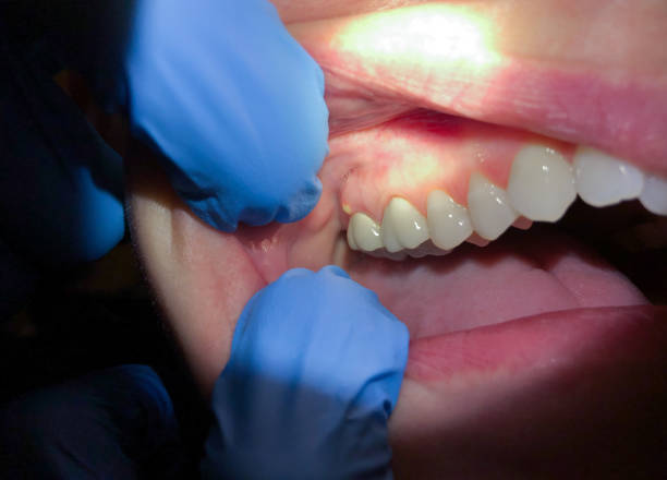 Best Emergency Care for Gum Disease in Ord, NE